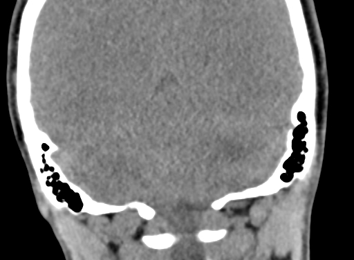 Angular dermoid cyst (Radiopaedia 88967-105790 Coronal non-contrast 95).jpg