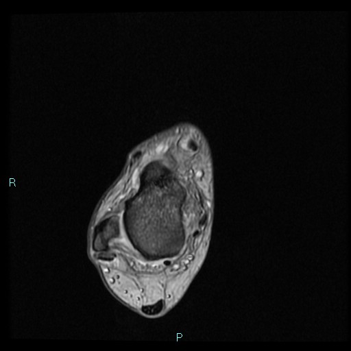 Ankle ganglion cyst (Radiopaedia 62809-71162 Axial Gradient Echo 54).jpg