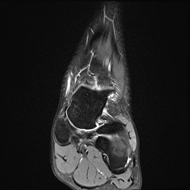 Ankle syndesmotic injury (Radiopaedia 69066-78837 Coronal PD fat sat 40).jpg