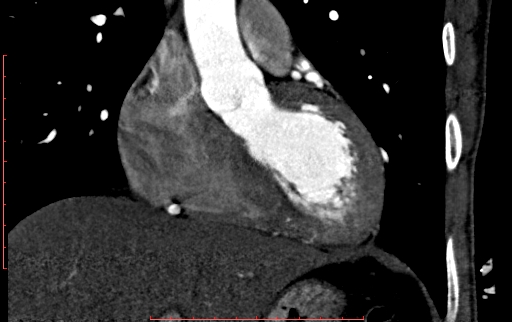 Anomalous left coronary artery from the pulmonary artery (ALCAPA) (Radiopaedia 70148-80181 B 124).jpg