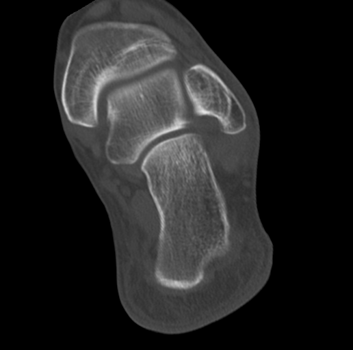 Anterior calcaneal process fracture (Radiopaedia 47384-51989 Coronal bone window 64).png