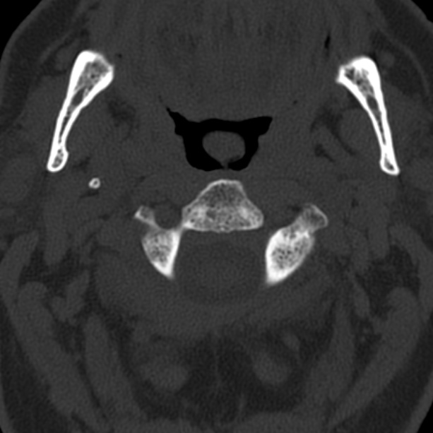 Anterior cervical postdiscectomy arthrodesis (Radiopaedia 32678-33646 Axial bone window 20).jpg