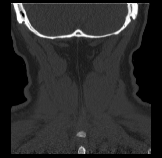 Anterior cervical postdiscectomy arthrodesis (Radiopaedia 32678-33646 Coronal bone window 69).jpg