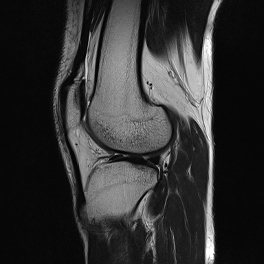 File:Anterior cruciate ligament full thickness tear (Radiopaedia 66268-75467 Sagittal T2 16).jpg