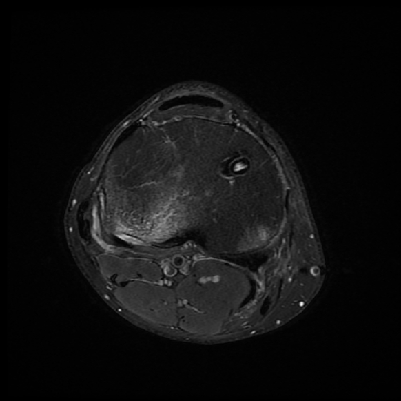 File:Anterior cruciate ligament graft tear and bucket-handle tear of medial meniscus (Radiopaedia 75867-87254 Axial PD fat sat 7).jpg