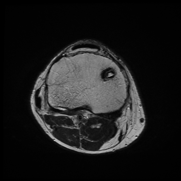 File:Anterior cruciate ligament graft tear and bucket-handle tear of medial meniscus (Radiopaedia 75867-87254 Axial T2 6).jpg