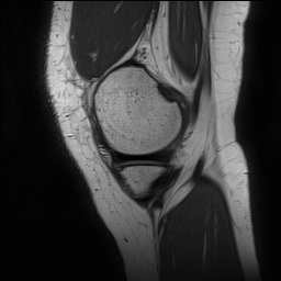 File:Anterior cruciate ligament rupture and posteromedial corner injury (Radiopaedia 67338-76723 Sagittal PD 37).jpg