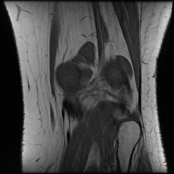 File:Anterior cruciate ligament tear, Wrisberg rip and bucket-handle tear of medial meniscus (Radiopaedia 75872-87266 Coronal T1 22).jpg