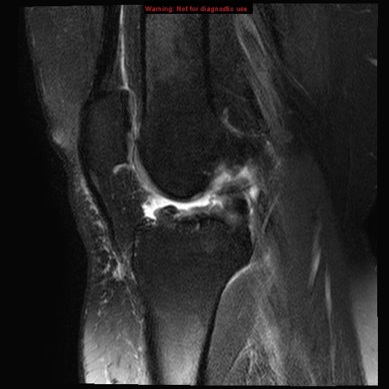 File:Anterior cruciate ligament tear - complete (Radiopaedia 12175-12514 Sagittal T2 fat sat 11).jpg