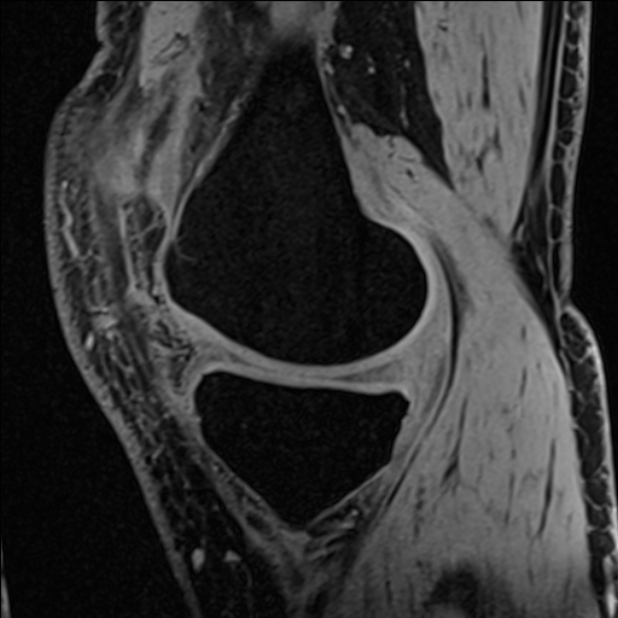 Anterior cruciate ligament tear - ramp lesion (Radiopaedia 71883-82322 Sagittal T1 vibe 97).jpg