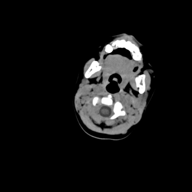 Anterior fontanelle inclusion cyst (Radiopaedia 62003-70087 Axial non-contrast 11).jpg
