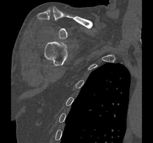 Anterior glenohumeral dislocation with Hill-Sachs lesion (Radiopaedia 62877-71249 Coronal bone window 18).jpg