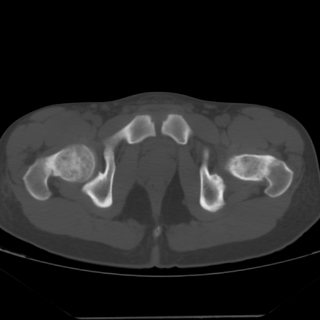 Anterior inferior iliac spine avulsion fracture (Radiopaedia 49469-54627 Axial bone window 47).jpg