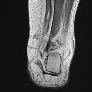 File:Anterior talofibular ligament injury - rupture with soft-tissue impingement (Radiopaedia 38765-40928 Coronal PD 9).jpg