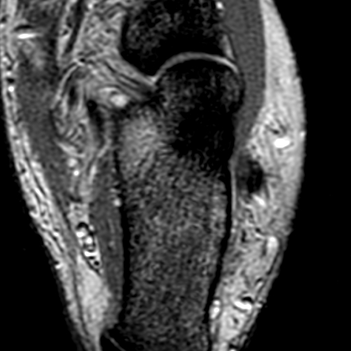 File:Anterior talofibular ligament rupture (Radiopaedia 15831-15484 Axial T2* 18).jpg