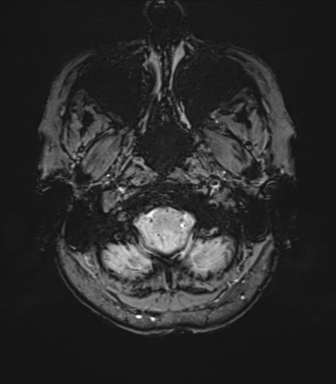 Anterior temporal lobe perivascular space (Radiopaedia 40946-43650 Axial SWI 7).png