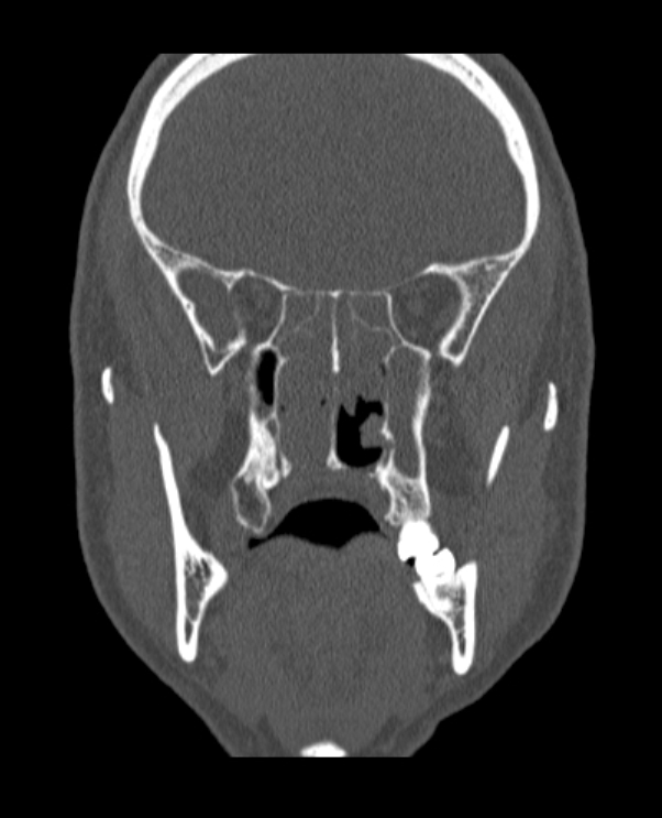 Antrochoanal polyp (Radiopaedia 79011-92169 Coronal bone window 35).jpg
