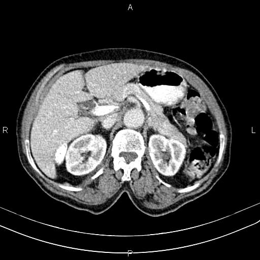 File:Aortic aneurysm and Lemmel syndrome (Radiopaedia 86499-102554 A 28).jpg