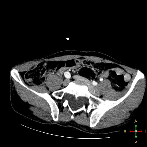 File:Aortic aneurysm and penetrating ulcer (Radiopaedia 23590-23704 A 41).jpg