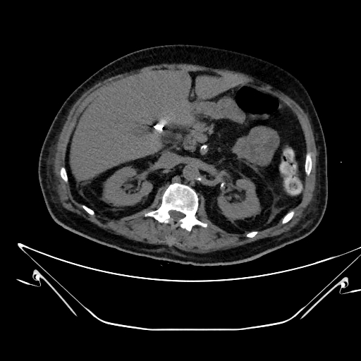 Aortic arch aneurysm (Radiopaedia 84109-99365 Axial non-contrast 311).jpg
