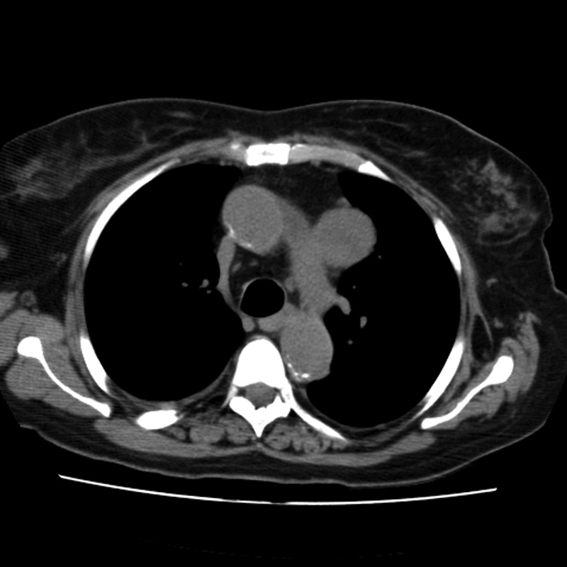 Aortic arch pseudoaneurysm (Radiopaedia 8534-9368 Axial non-contrast 26).jpg