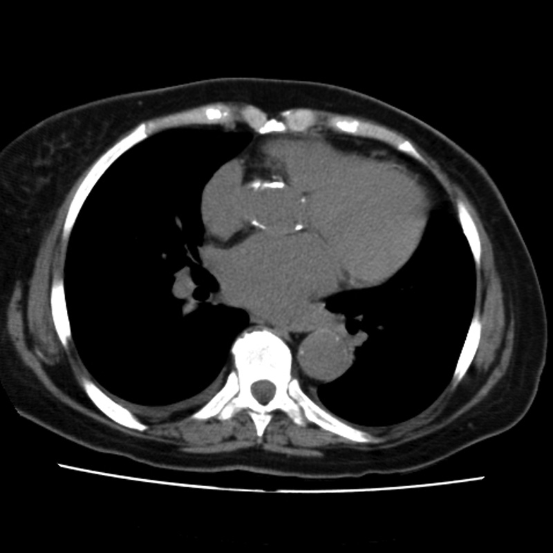 Aortic arch pseudoaneurysm (Radiopaedia 8534-9368 Axial non-contrast 45).jpg