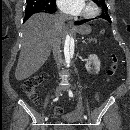 Aortic dissection- Stanford A (Radiopaedia 35729-37268 F 30).jpg
