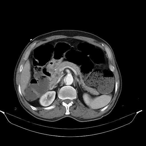 Aortic dissection- Stanford type A (Radiopaedia 22085-22085 A 44).jpg