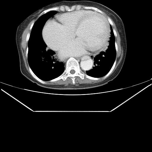 File:Aortic dissection (Radiopaedia 25350-25604 C 35).jpg