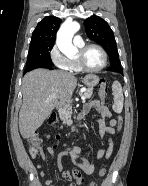 Aortic dissection (Radiopaedia 44411-48061 A 11).jpg