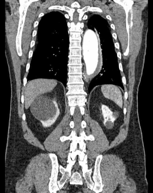 Aortic dissection (Radiopaedia 44411-48061 A 52).jpg