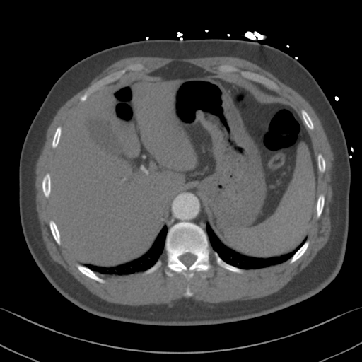 File:Aortic dissection (Radiopaedia 50763-56234 A 70).png