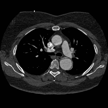 Aortic dissection (Radiopaedia 57969-64959 A 127).jpg