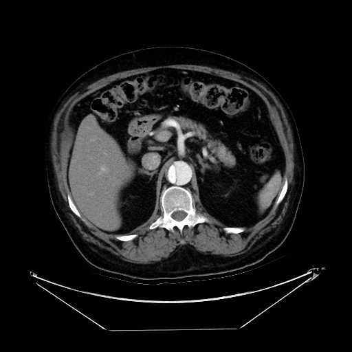 Aortic dissection (Radiopaedia 62562-71000 A 54).jpg