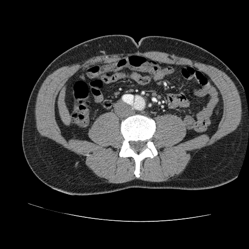 File:Aortic dissection - Stanford A -DeBakey I (Radiopaedia 28339-28587 B 155).jpg