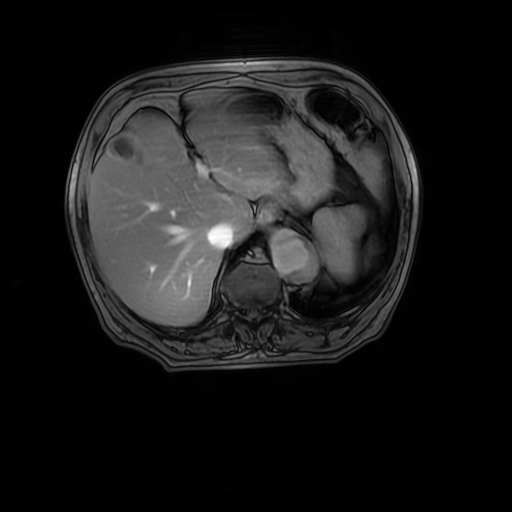 File:Aortic dissection - Stanford A - DeBakey I (Radiopaedia 23469-23551 Axial MRA 35).jpg