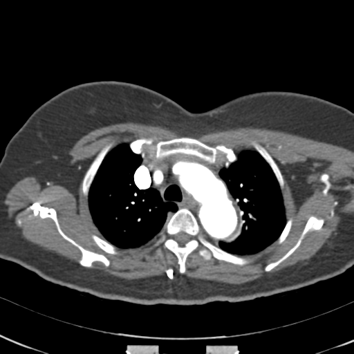 File:Aortic dissection - Stanford type A (Radiopaedia 39073-41259 A 19).png