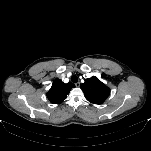 File:Aortic dissection - Stanford type A (Radiopaedia 83418-98500 A 10).jpg