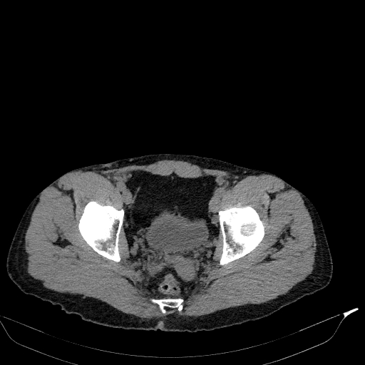 Aortic dissection - Stanford type A (Radiopaedia 83418-98500 Axial non-contrast 86).jpg