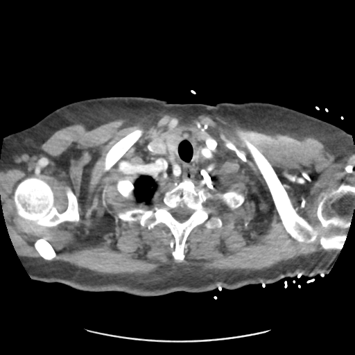 Aortic dissection - Stanford type B (Radiopaedia 50171-55512 A 4).png