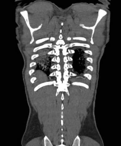 File:Aortic dissection - Stanford type B (Radiopaedia 73648-84437 B 106).jpg