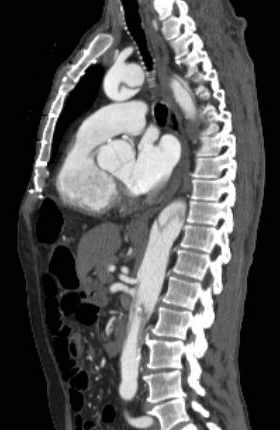 File:Aortic dissection - Stanford type B (Radiopaedia 73648-84437 C 71).jpg