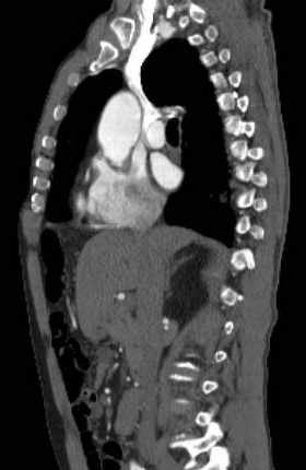 Aortic dissection - Stanford type B (Radiopaedia 73648-84437 C 90).jpg