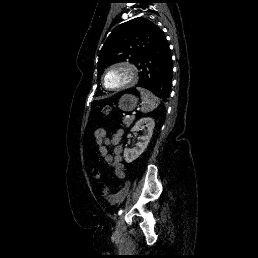 Aortic dissection - Stanford type B (Radiopaedia 88281-104910 C 65).jpg