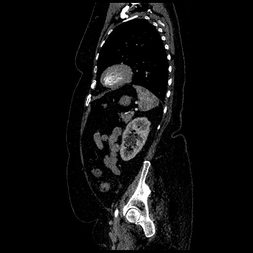 File:Aortic dissection - Stanford type B (Radiopaedia 88281-104910 C 67).jpg