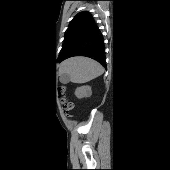 Aortic intramural hematoma (type B) (Radiopaedia 79323-92387 G 3).jpg