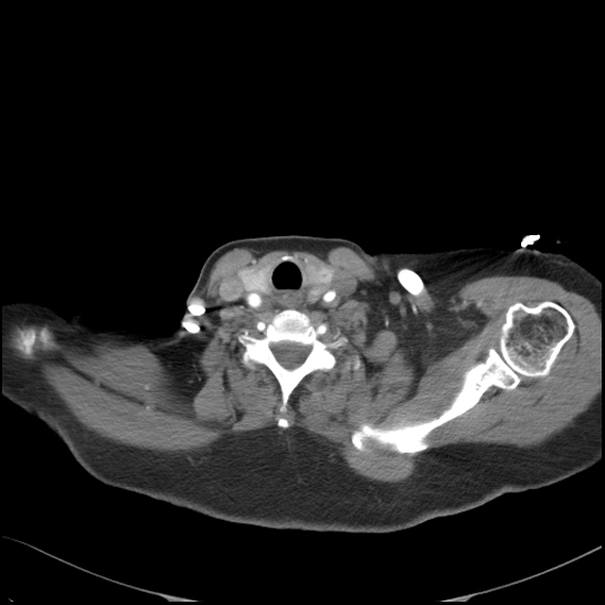 Aortic intramural hematoma with dissection and intramural blood pool (Radiopaedia 77373-89491 B 19).jpg
