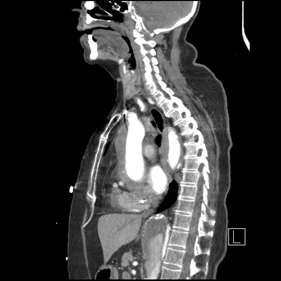 File:Aortic intramural hematoma with dissection and intramural blood pool (Radiopaedia 77373-89491 D 45).jpg
