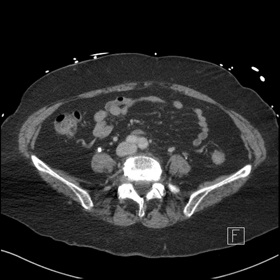 File:Aortic intramural hematoma with dissection and intramural blood pool (Radiopaedia 77373-89491 E 60).jpg