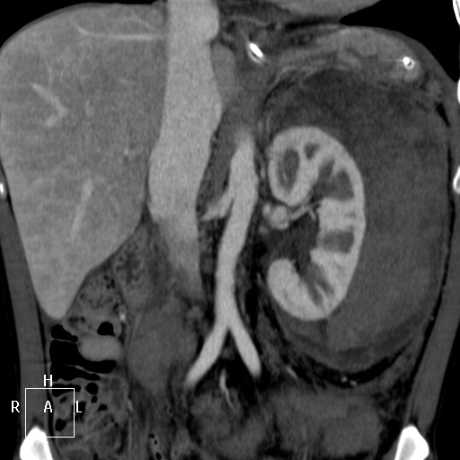 Aorto-left renal vein fistula (Radiopaedia 45534-49628 B 33).jpg